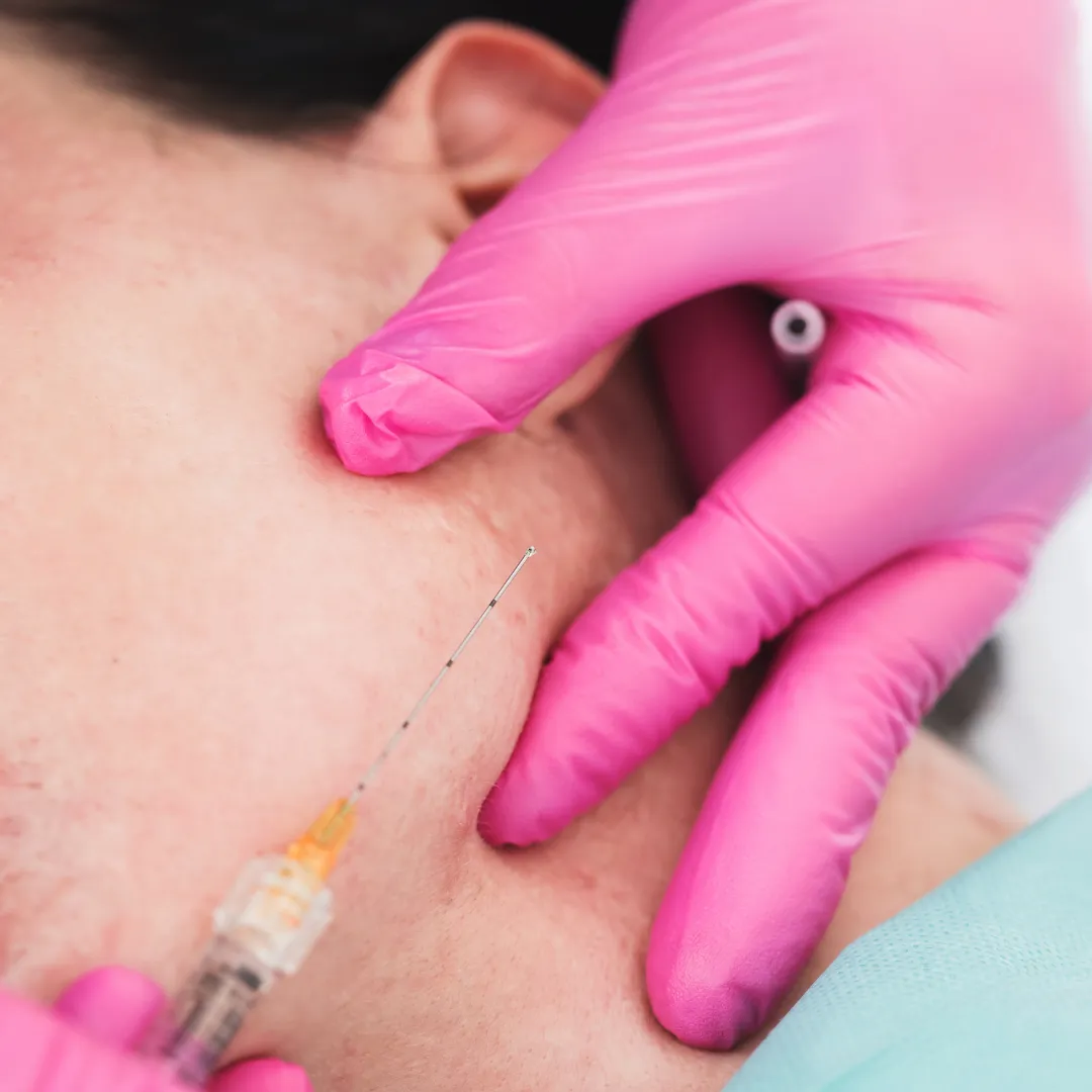 Treatment with Dermal threads