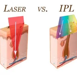 IPL for permanent hair removal: All you need to know