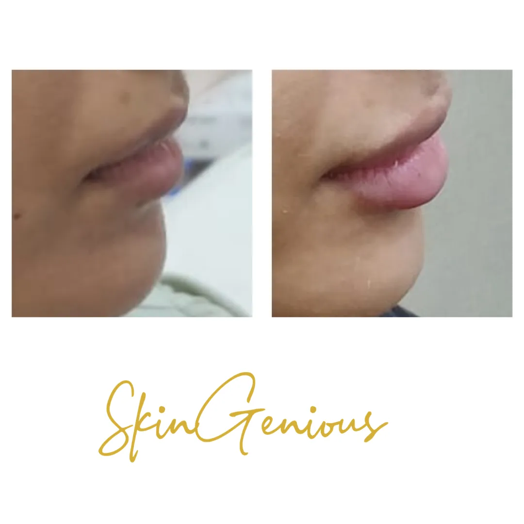 Dermal Filler