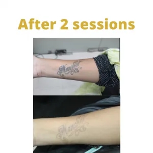 Laser Tattoo Removal