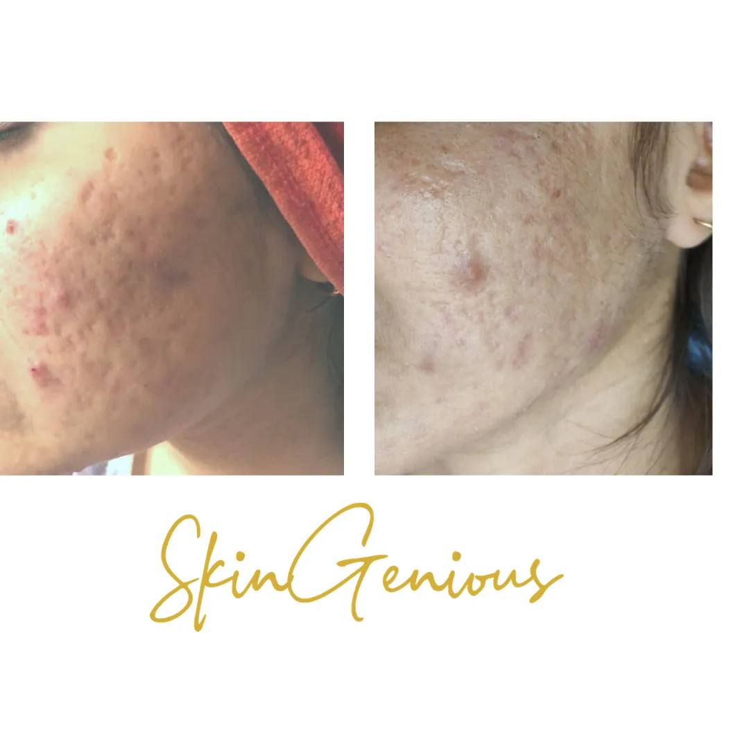 Salicylic peel