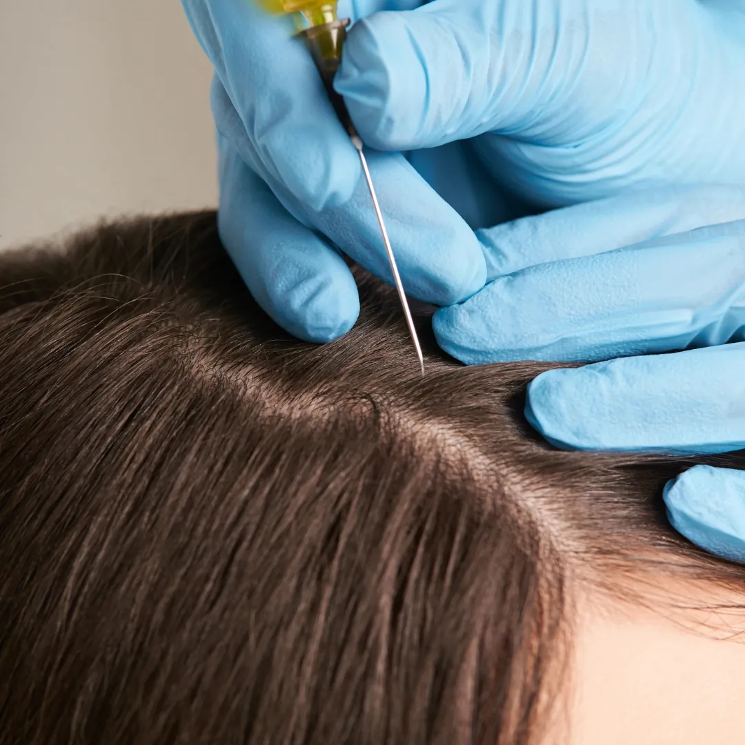 PRP injection