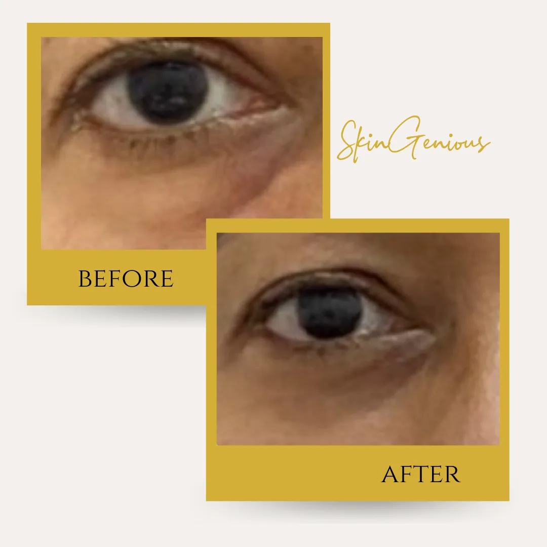 Under eye bags