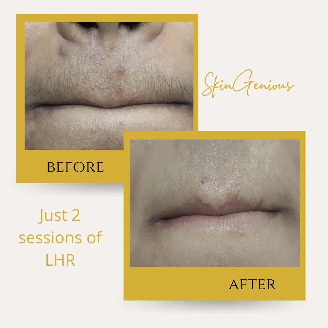 Laser Hair Removal