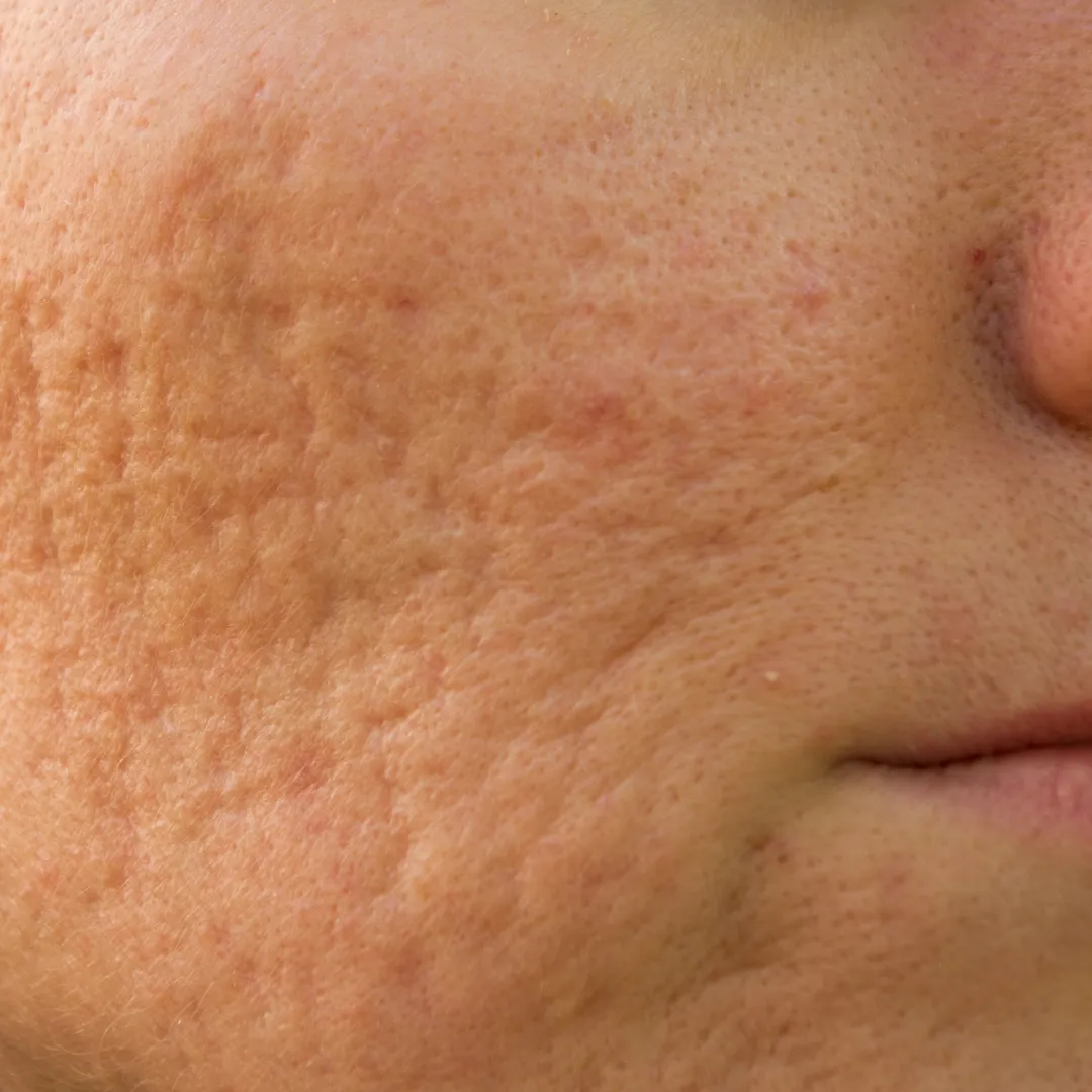 Acne scars