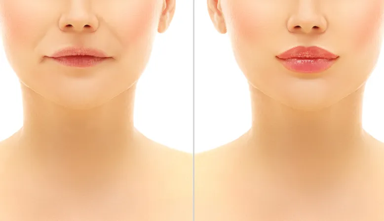 Lip augmentation treatment in Jaipur