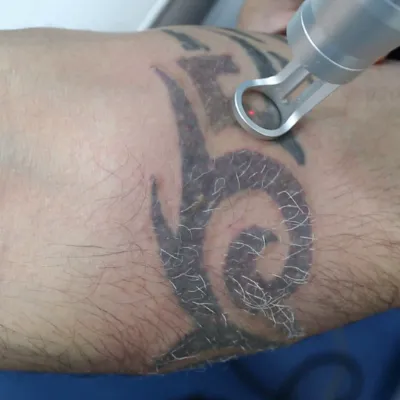 Laser Tattoo Removal