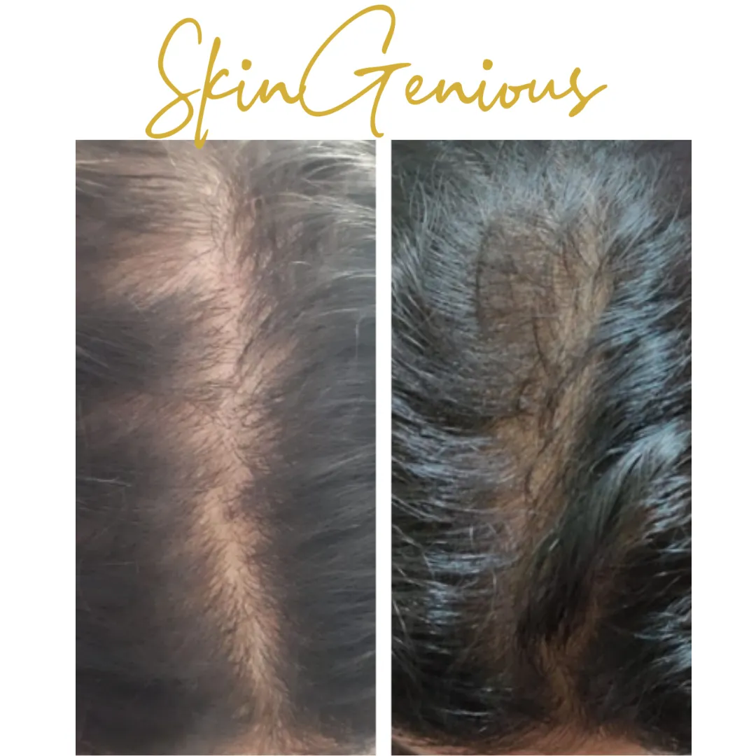 Before and after: PRP hair treatment for Hair loss