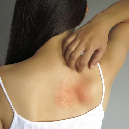 Skin medications treatment in Mumbai