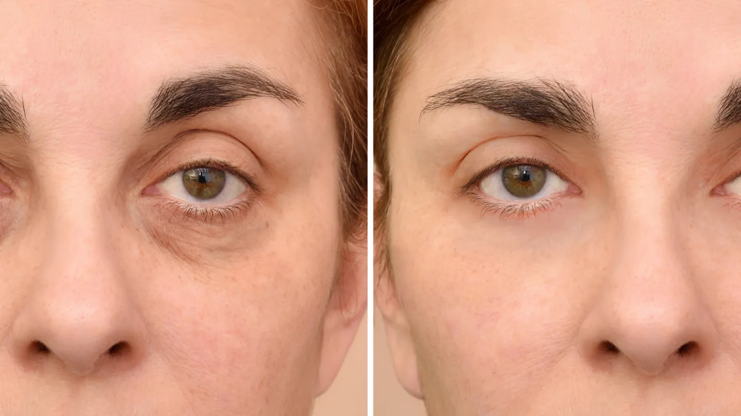 Under eye bags treatment in Jaipur