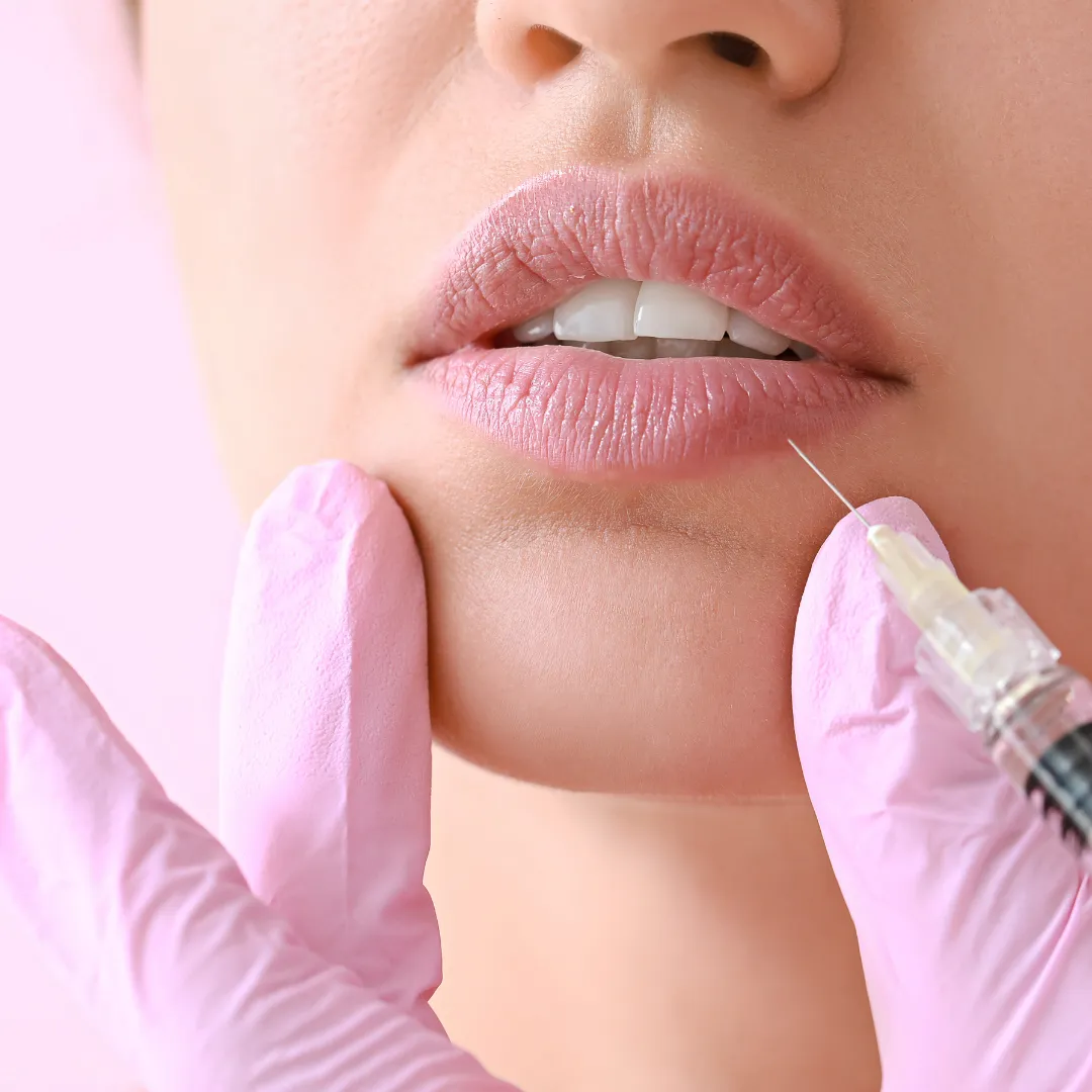 Lip augmentation