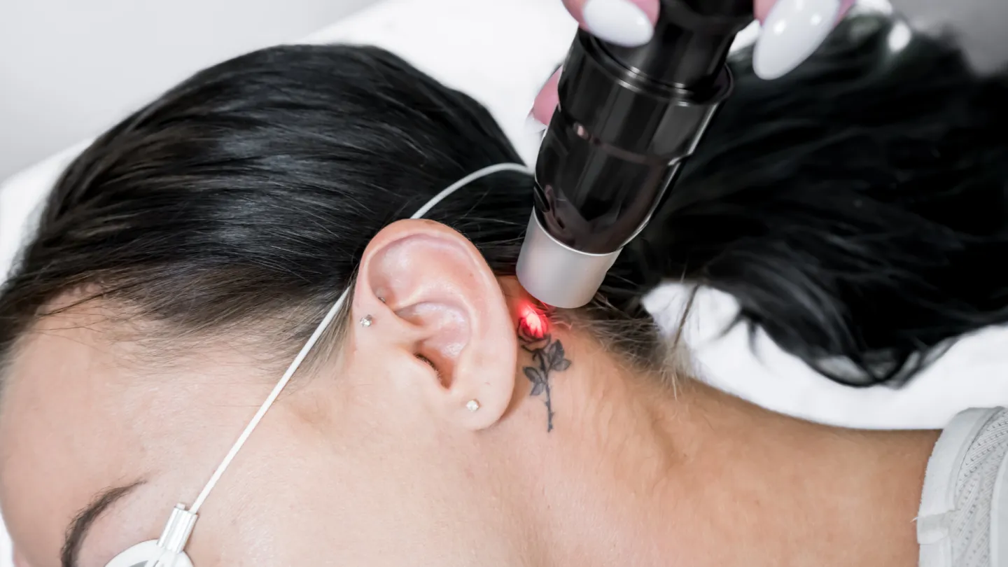 Unwanted tattoo treatment in Mumbai