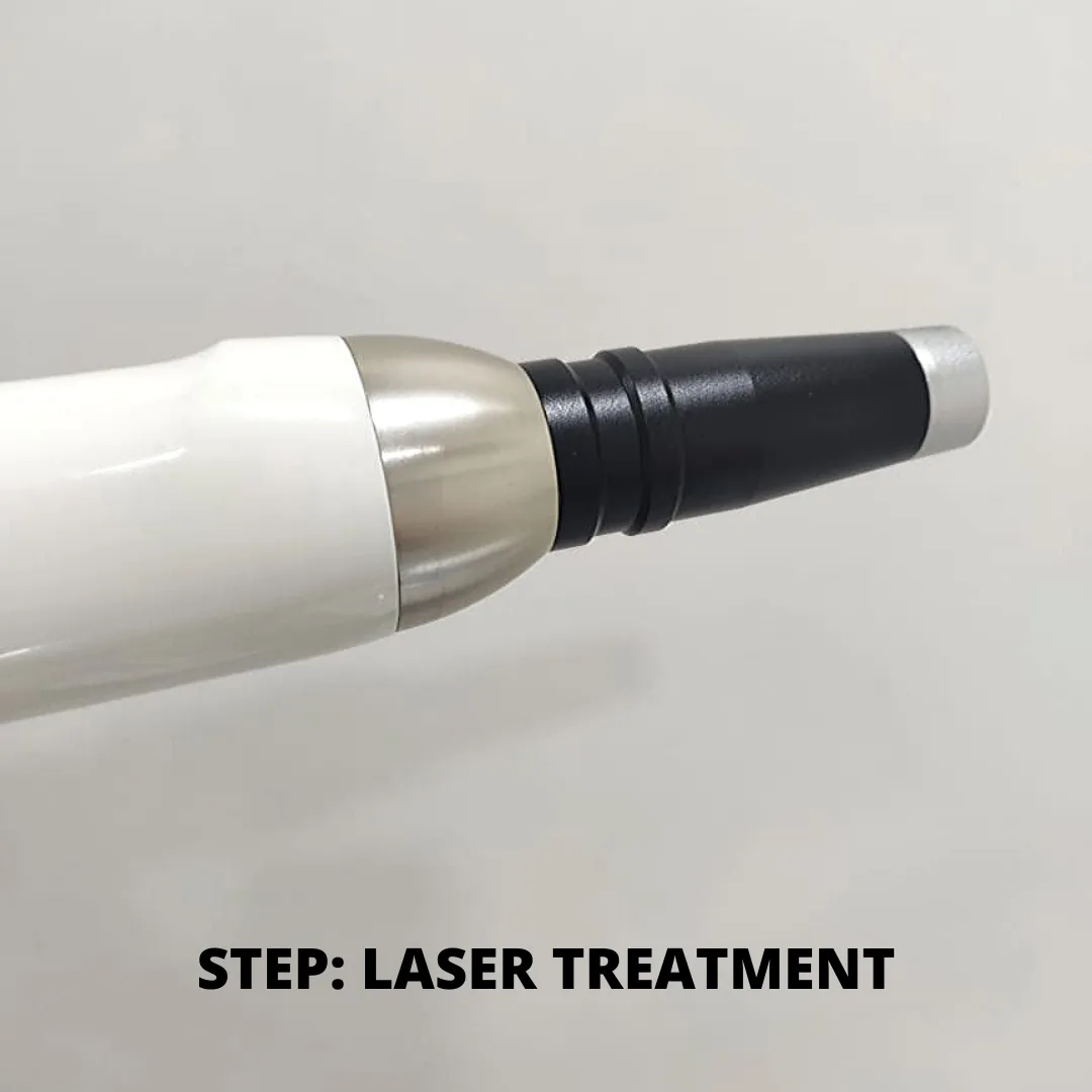 Laser Tattoo Removal treatment in Mumbai