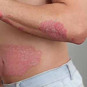 Psoriasis