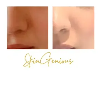 Skin Whitening