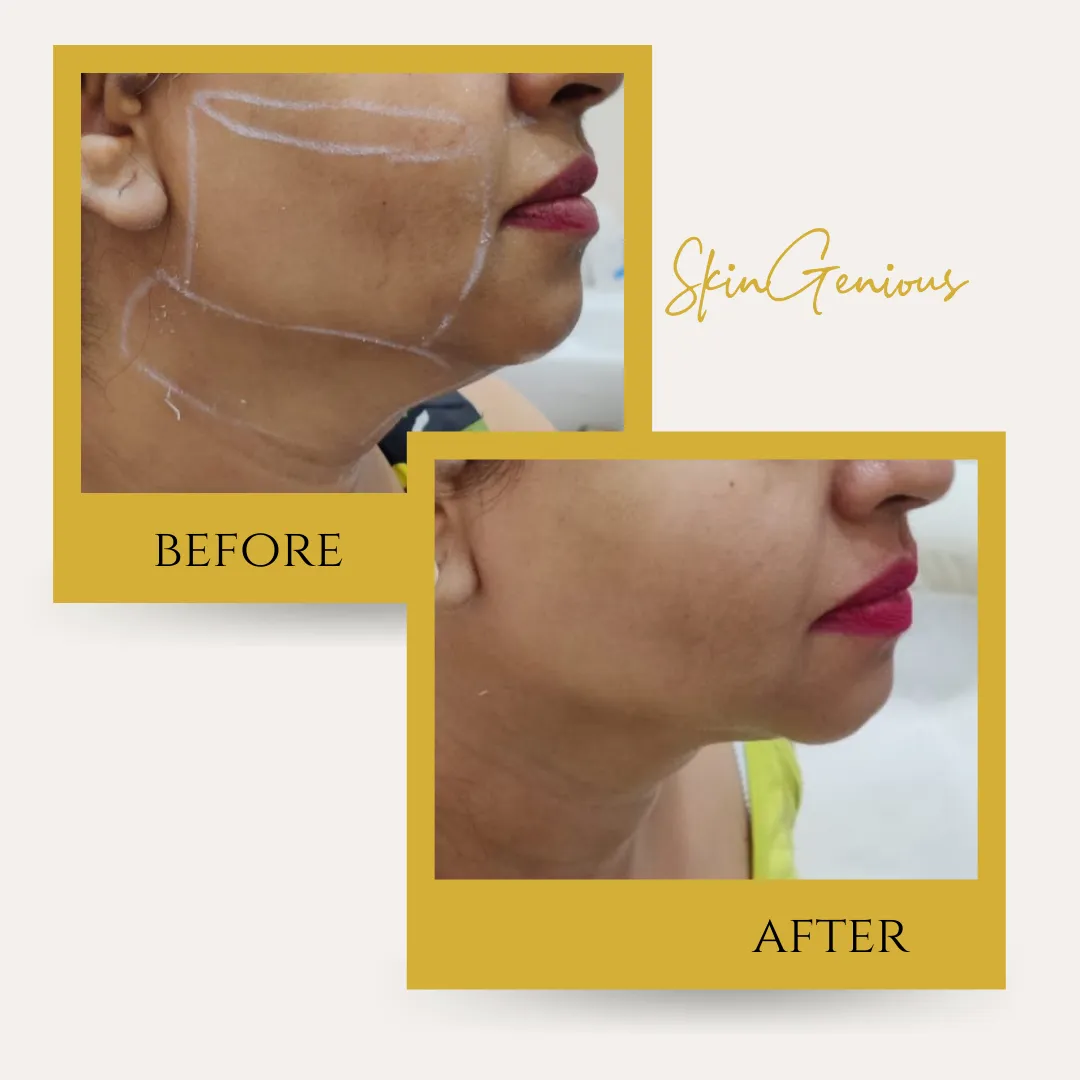 HIFU Facelift