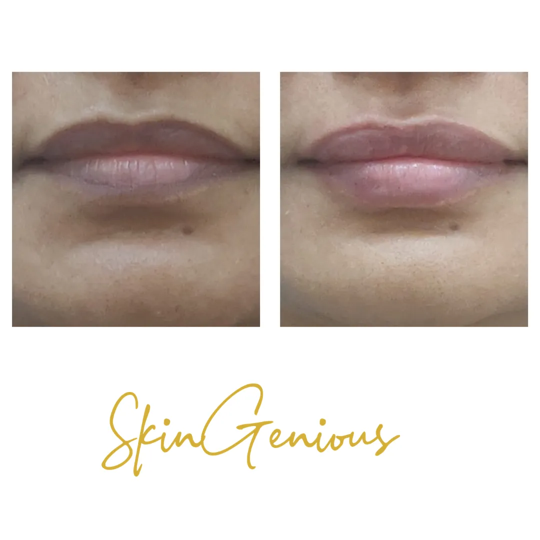 Dermal Filler
