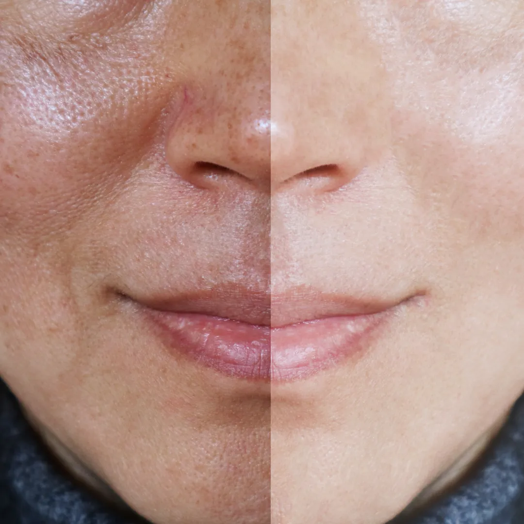 open pores