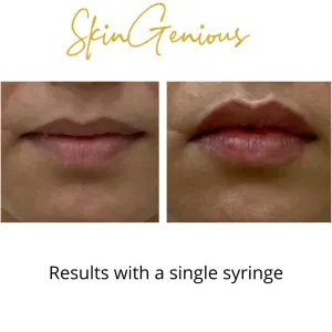 Dermal Filler