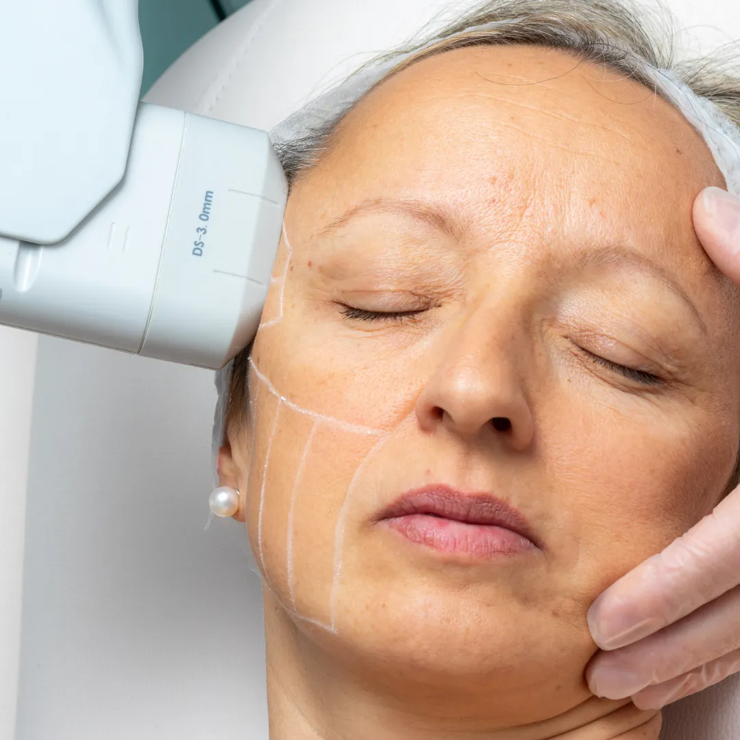 HIFU Facelift