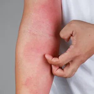 Eczema