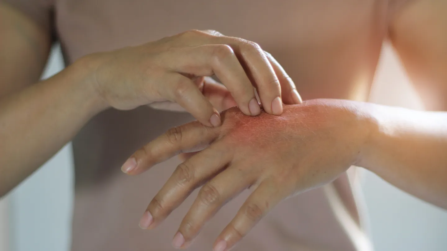 Psoriasis treatment in Jaipur