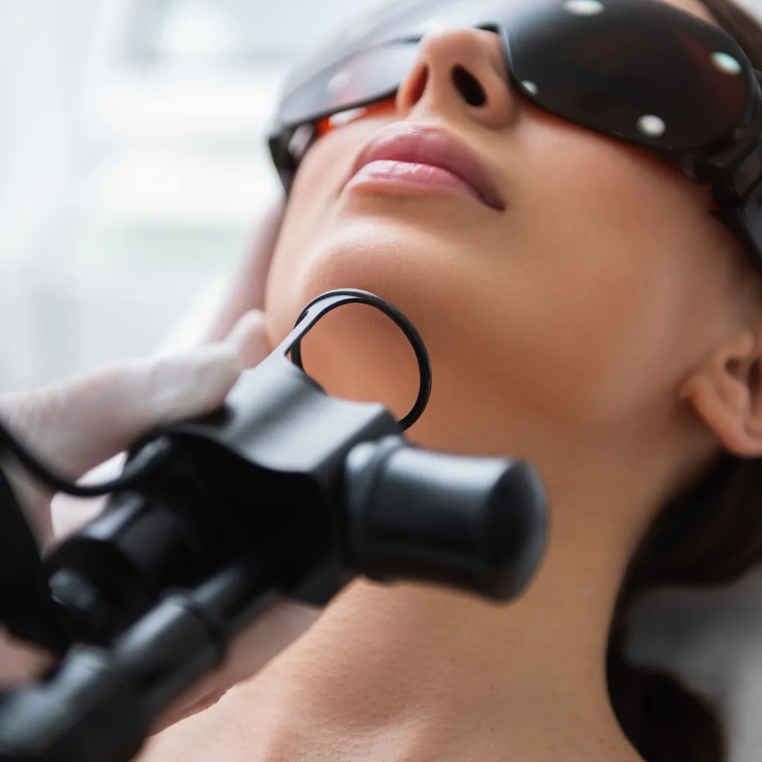 Fractional Co2 Laser Resurfacing