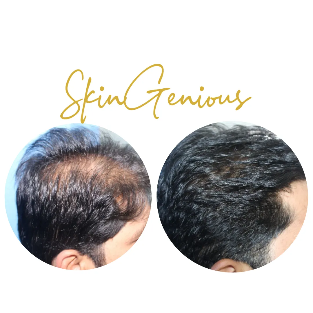 Before and after: PRP hair treatment for Hair loss