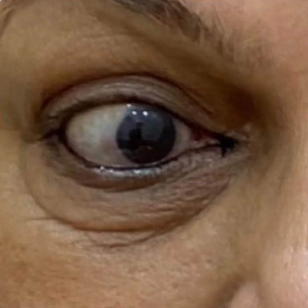 Under eye bags
