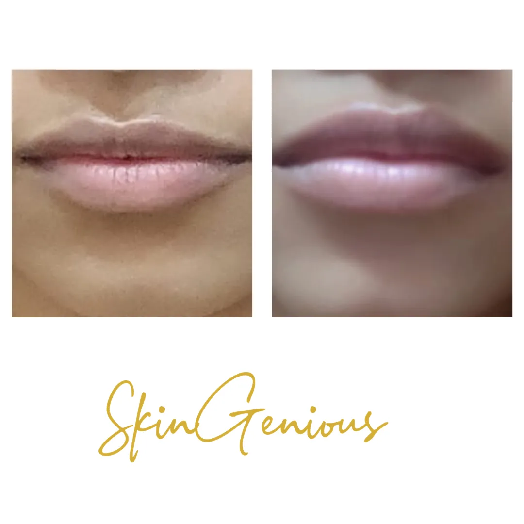 Dermal Filler