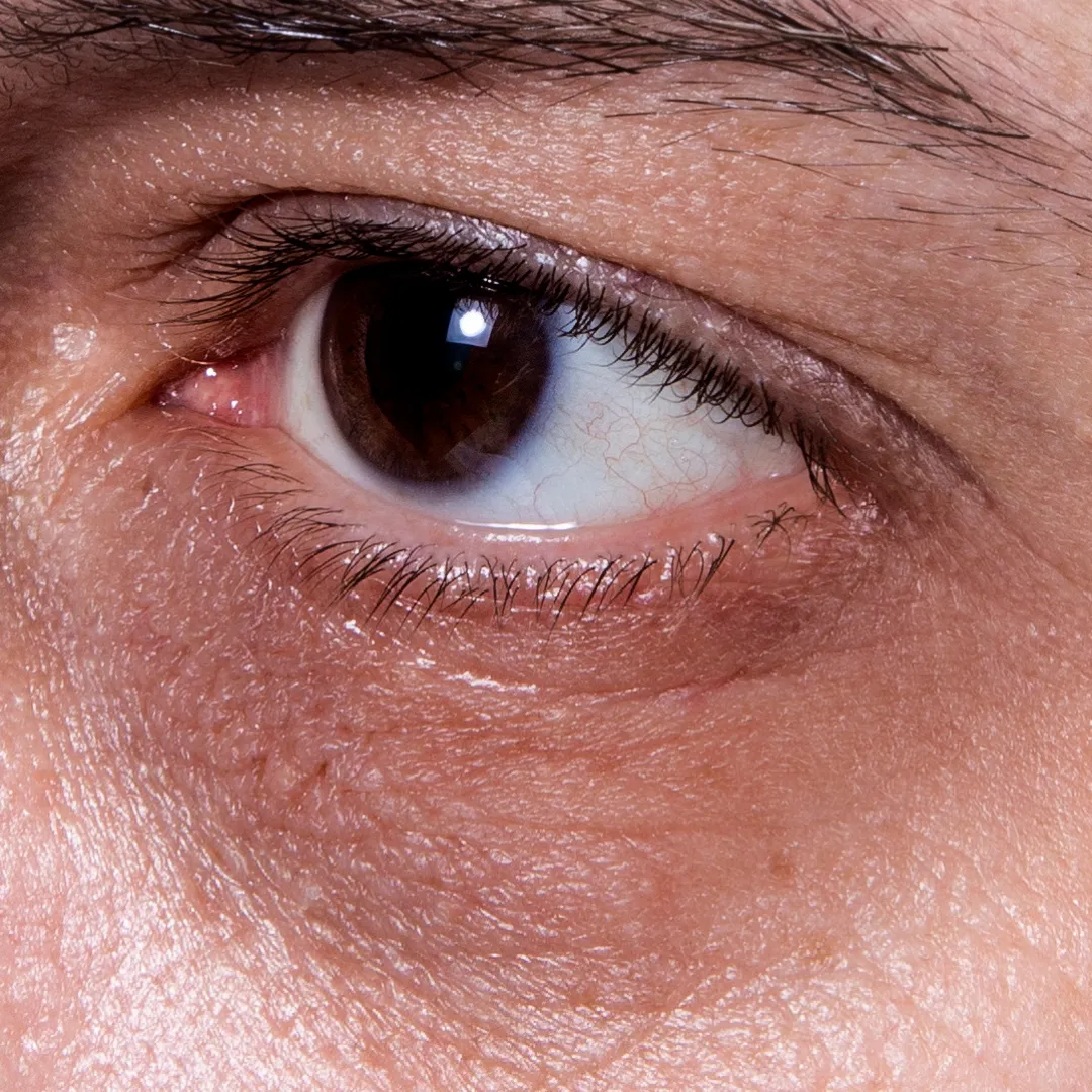 Dark circles