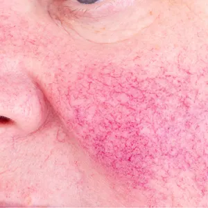 Rosacea