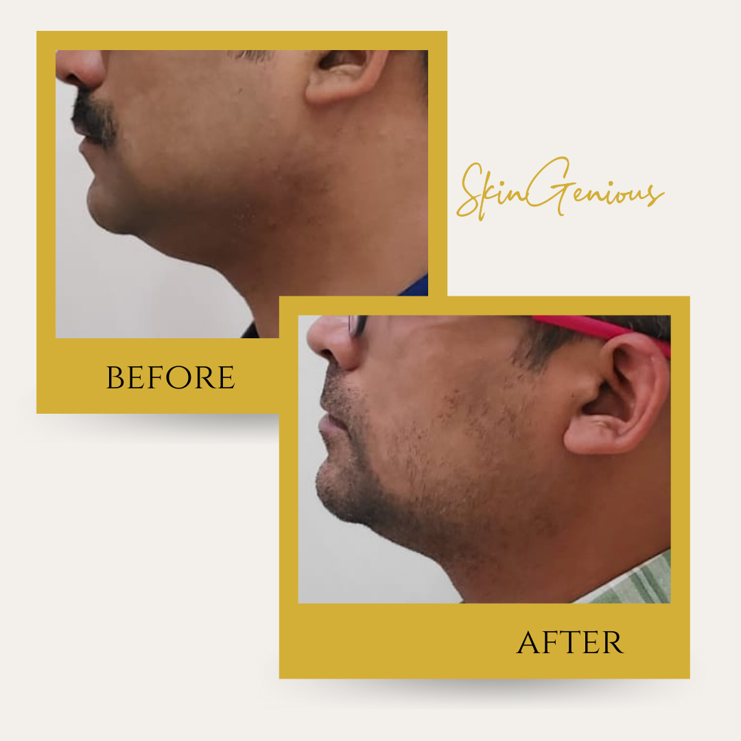 Skin Tightening (RF)