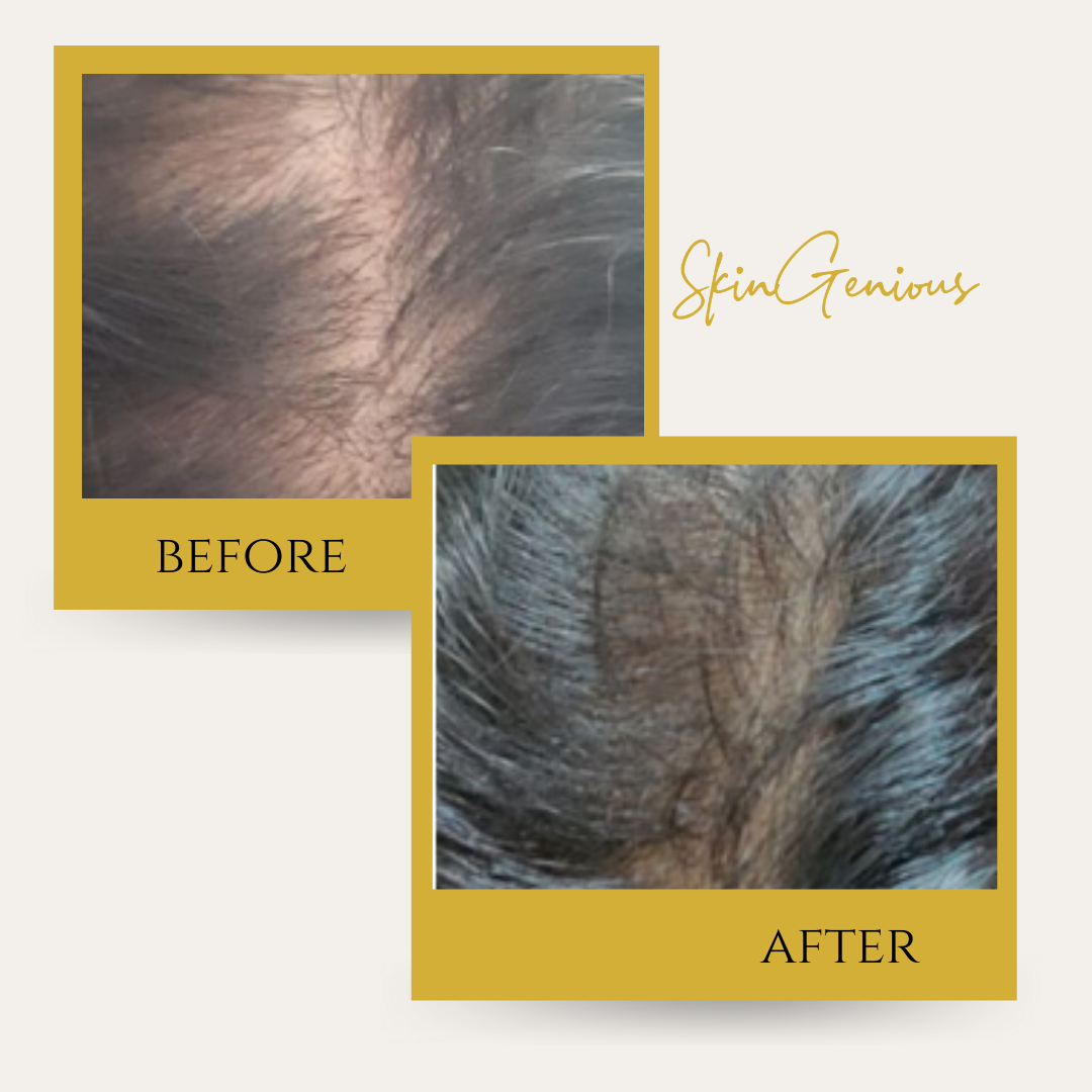 Hair loss