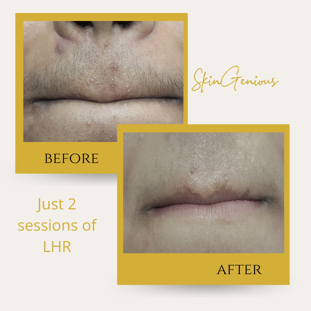 Laser Hair Removal