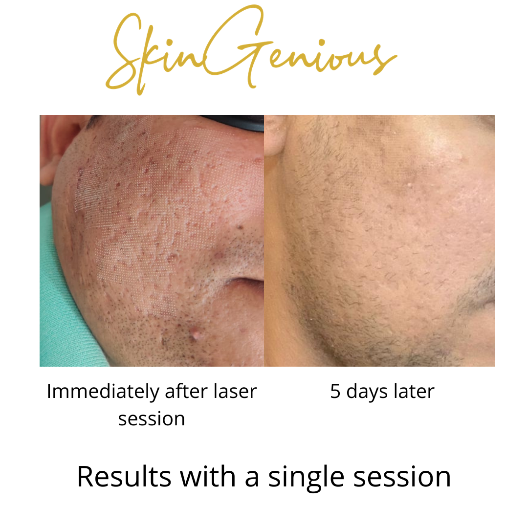Acne scars