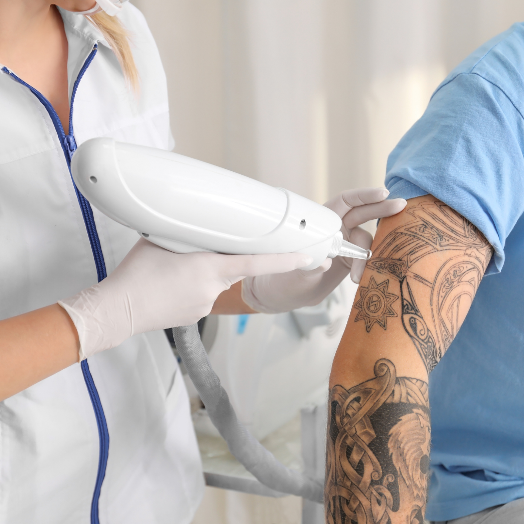 Laser Tattoo Removal