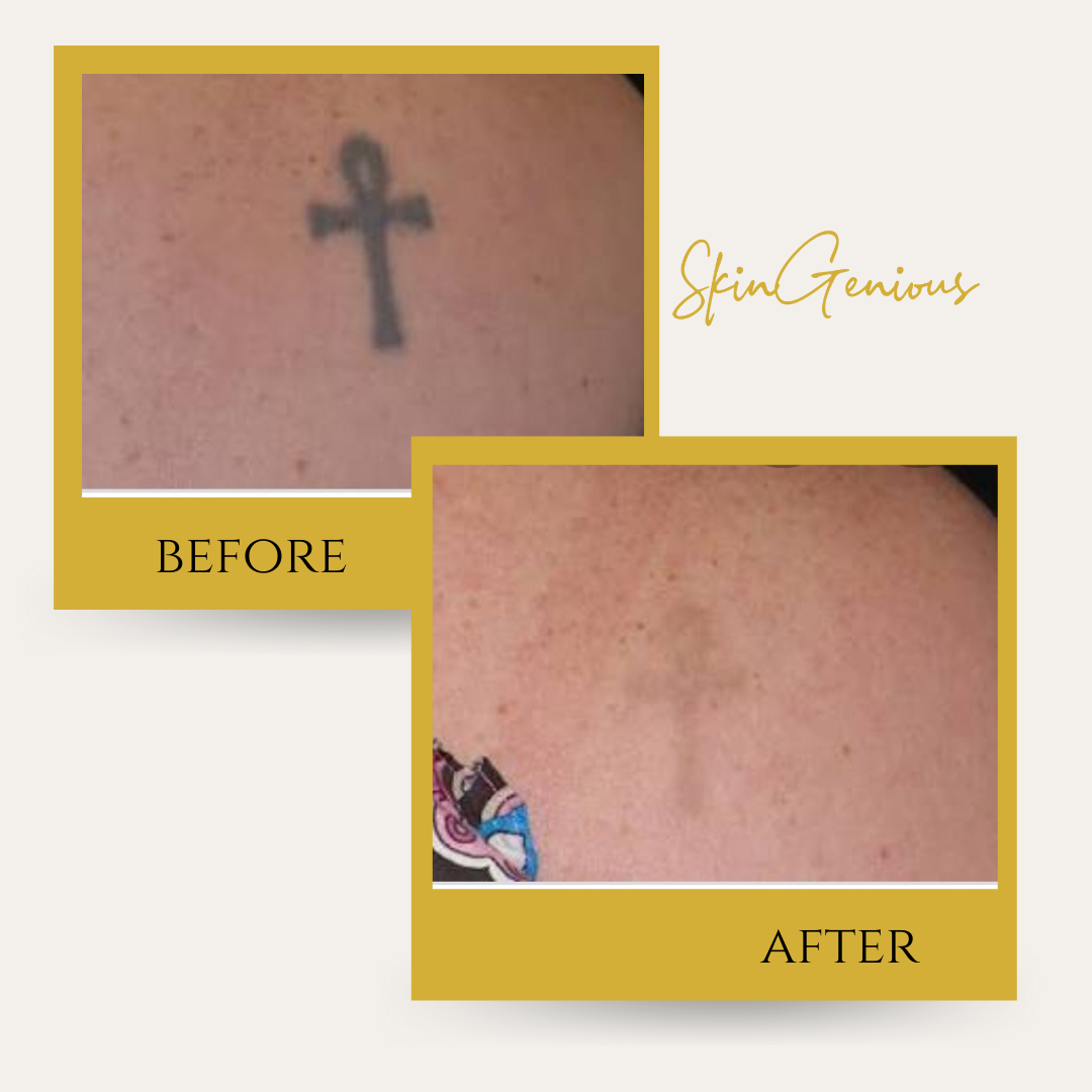 Unwanted tattoo