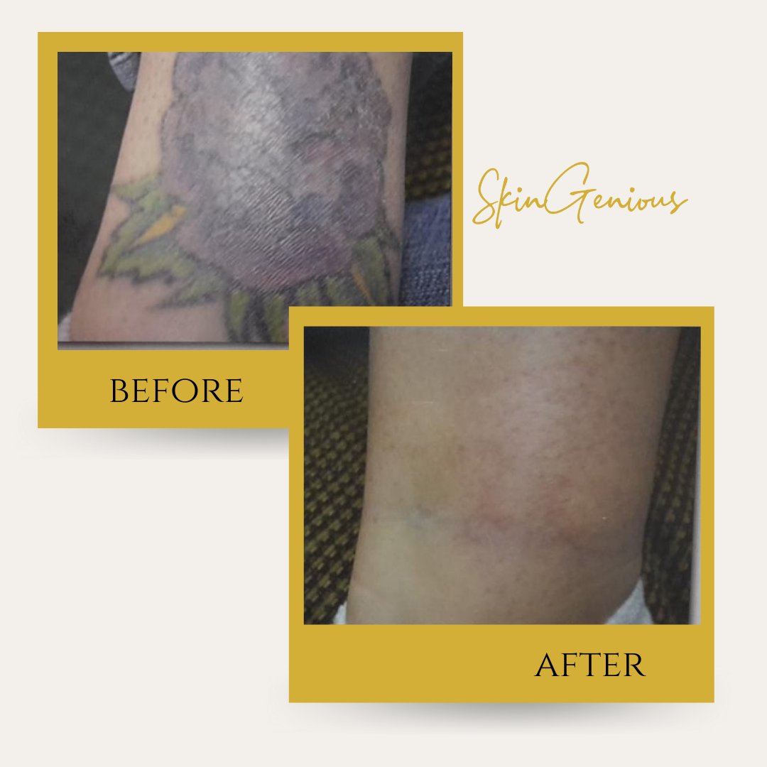 Laser Tattoo Removal