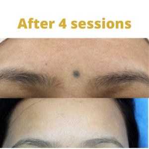 Laser Tattoo Removal