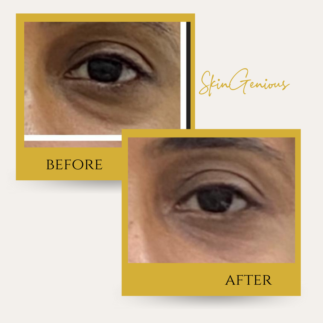 Dark circles