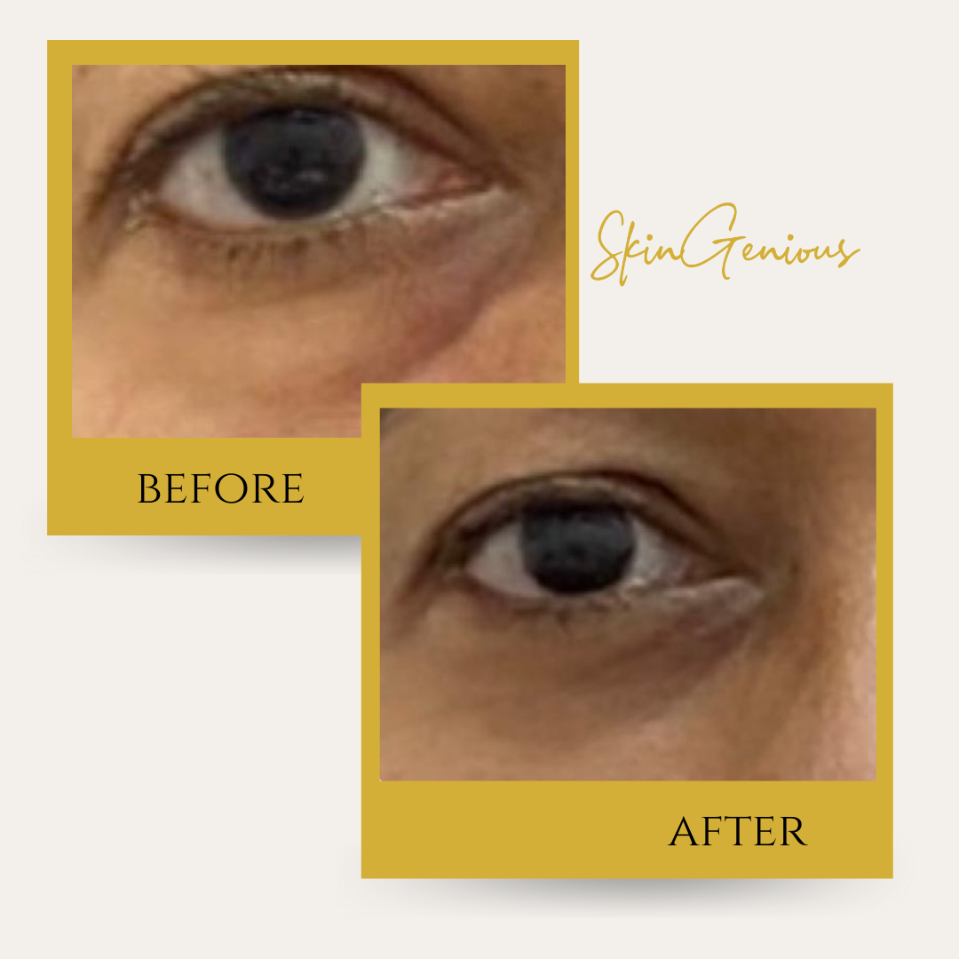 Under eye bags