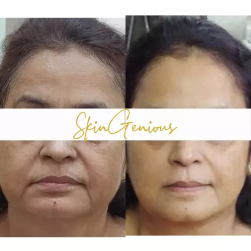 Best Treatment for Deep Wrinkles on Face in Mumbai - PHI Clinics