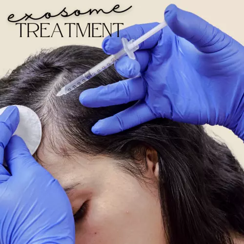 Exosome treatment for hair