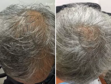 Exosome treatment for hair