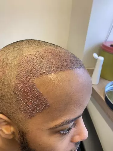 Hair Transplant
