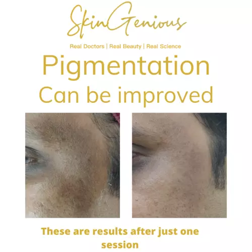 Hyperpigmentation