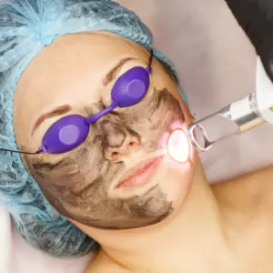 Carbon Laser Facial